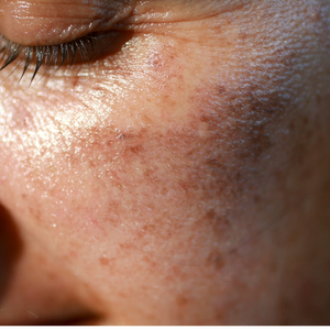 PIGMENTATION